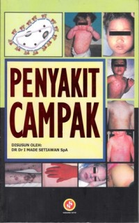 Image of Penyakit Campak